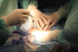 לא בוצע ניתוח קיסרי: בית חולים זיו יפצה ב-2.6 מיליון ש"ח